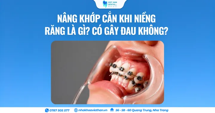 Nâng khớp cắn khi niềng răng là gì? Có gây đau không?
