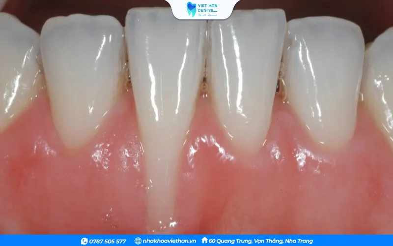 Dấu hiệu bật chân răng, tiêu xương hàm sau quá trình niềng