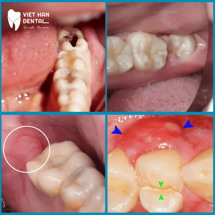 Trường hợp nào được chỉ định nhổ răng khôn?