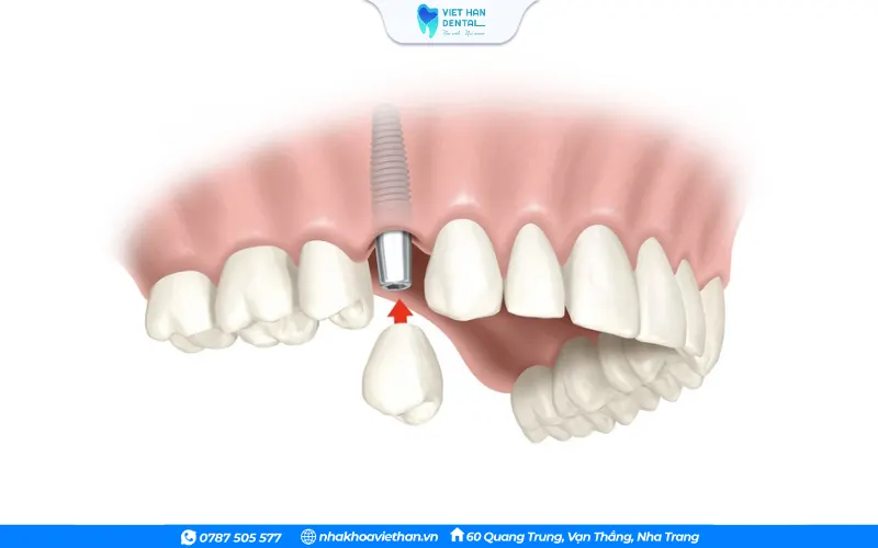 Cấy ghép Implant chịu lực tức thì giúp rút ngắn thời gian cấy ghép