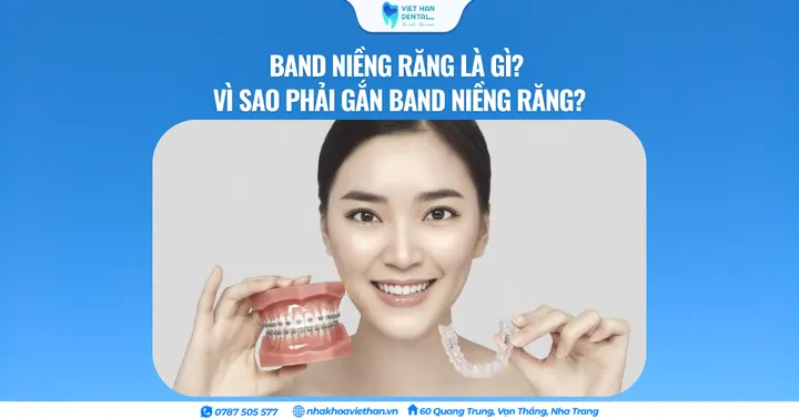 Band niềng răng là gì? Vì sao phải gắn band niềng răng?
