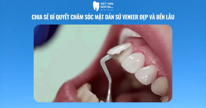 Chia sẻ bí quyết chăm sóc mặt dán sứ Veneer đẹp và bền lâu