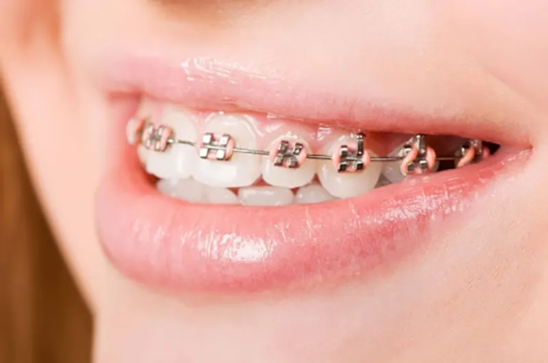 Khách hàng sử dụng mắc cài kim loại