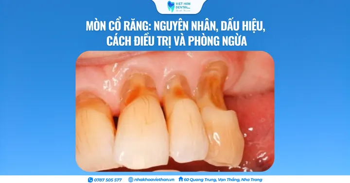 Mòn cổ răng: Nguyên nhân, dấu hiệu, cách điều trị và phòng ngừa