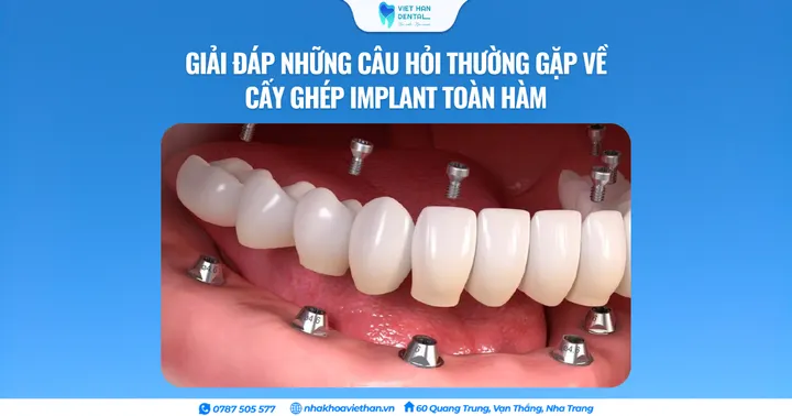 Giải đáp những câu hỏi thường gặp về cấy ghép Implant toàn hàm 