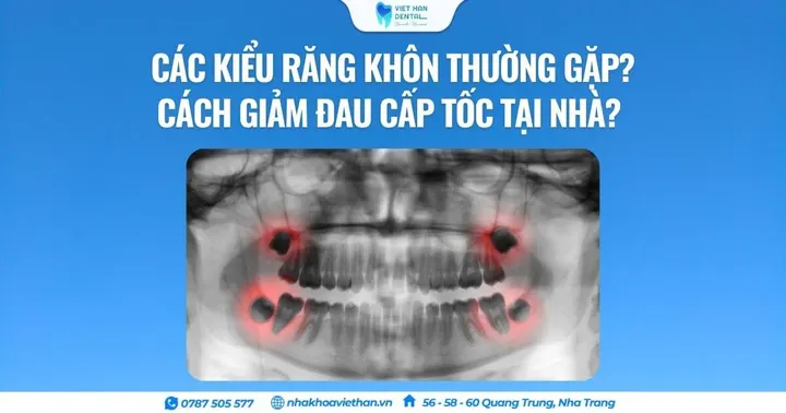 Các kiểu răng khôn thường gặp? Cách giảm đau cấp tốc tại nhà?
