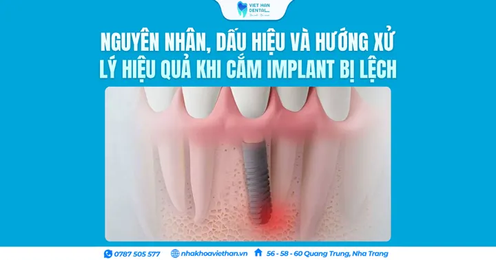 Nguyên nhân, dấu hiệu và hướng xử lý hiệu quả khi cắm Implant bị lệch