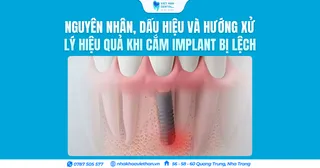 Nguyên nhân, dấu hiệu và hướng xử lý hiệu quả khi cắm Implant bị lệch