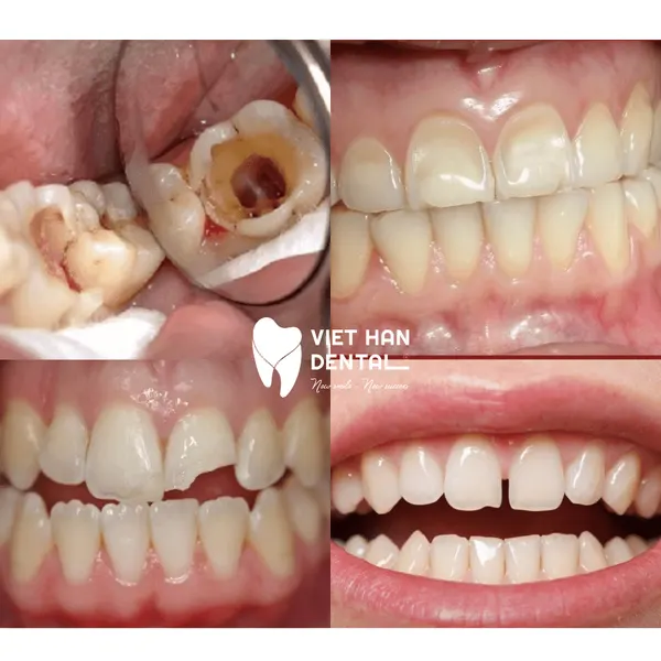 Trường hợp nên hàn trám răng