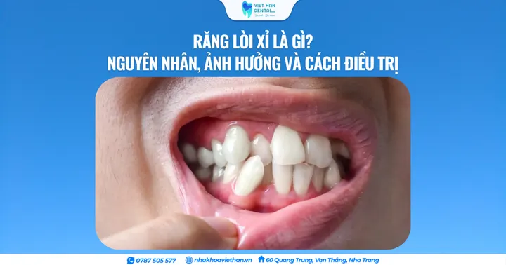 Răng lòi xỉ là gì? Nguyên nhân, ảnh hưởng và cách điều trị