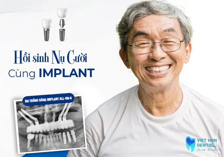 Trồng Răng Implant All-On-6