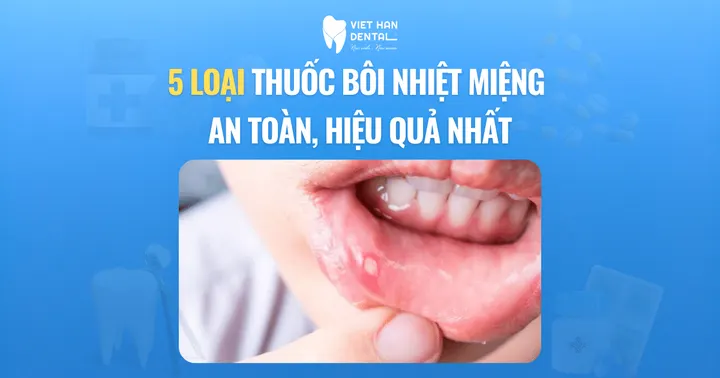 5 loại thuốc bôi nhiệt miệng an toàn, hiệu quả nhất