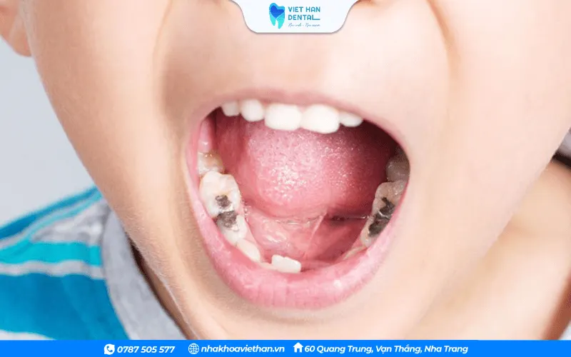 Sâu răng dễ khiến vi khuẩn xâm nhập gây viêm, hình thành áp xe răng