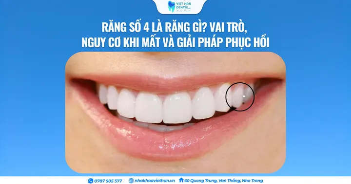 Răng số 4 là răng gì? Vai trò, nguy cơ khi mất và giải pháp phục hồi