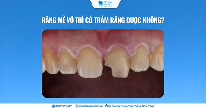 Răng mẻ vỡ thì có trám răng được không?