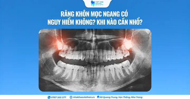 Răng khôn mọc ngang có nguy hiểm không? Khi nào cần nhổ?