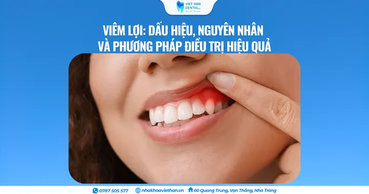 Viêm lợi: Dấu hiệu, nguyên nhân và phương pháp điều trị hiệu quả