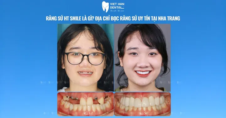 Răng sứ HT Smile là gì? Địa chỉ bọc răng sứ uy tín tại Nha Trang