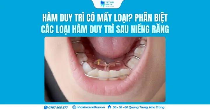Hàm duy trì có mấy loại? Phân biệt các loại hàm duy trì sau niềng răng