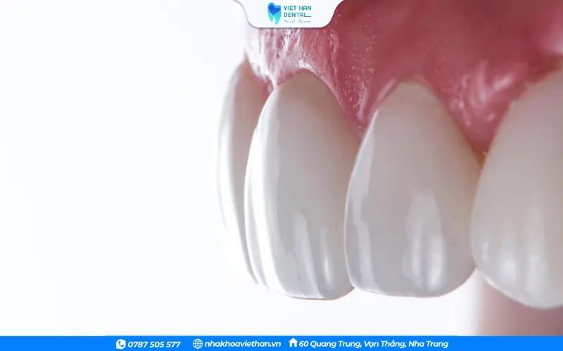 Bọc sứ 1 răng cửa