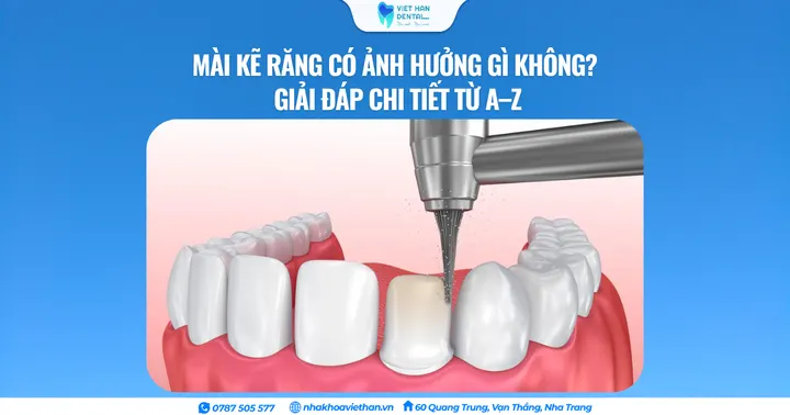 Mài kẽ răng có ảnh hưởng gì không? Giải đáp chi tiết từ A–Z