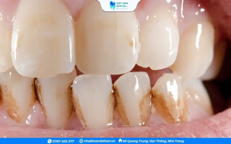 Men răng sẽ mòn dần, lộ lớp ngà