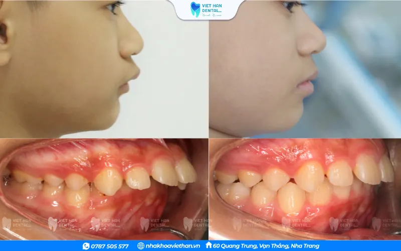 Khách hàng niềng răng tăng trưởng tại Nha khoa Việt Hàn