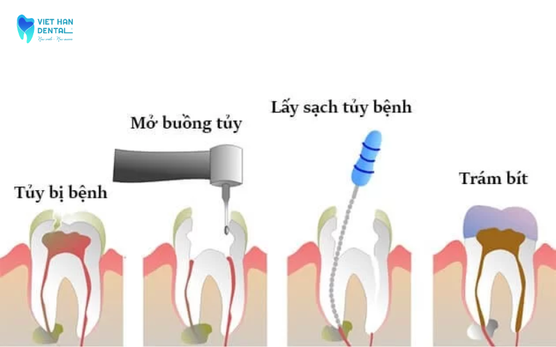 Làm sạch hệ thống ống tủy