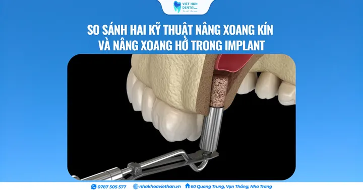 So sánh hai kỹ thuật nâng xoang kín và nâng xoang hở trong Implant