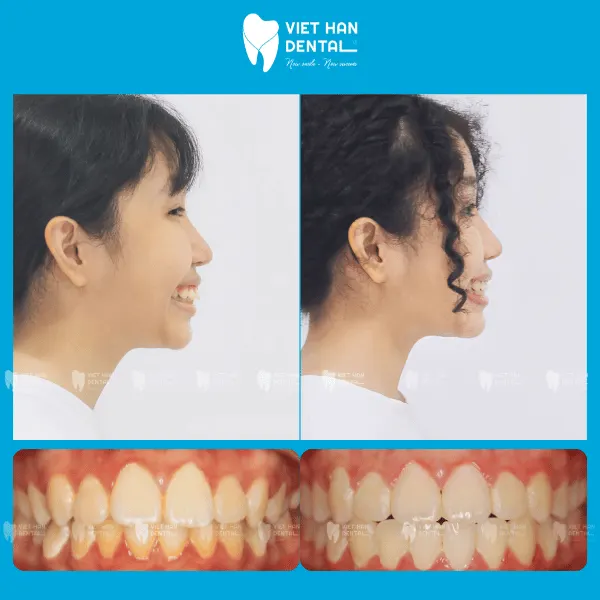 Nha khoa Việt Hàn niềng răng tăng trưởng thành công cho trẻ