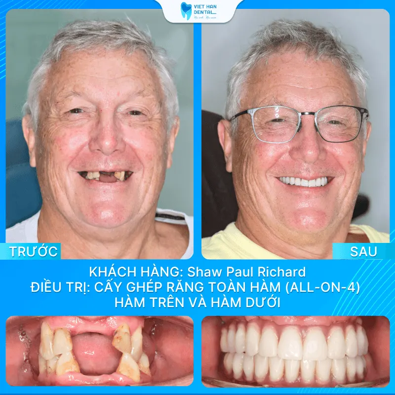 Ông Shaw Paul Richard trước và sau khi cấy ghép Implant All-on-4 toàn hàm