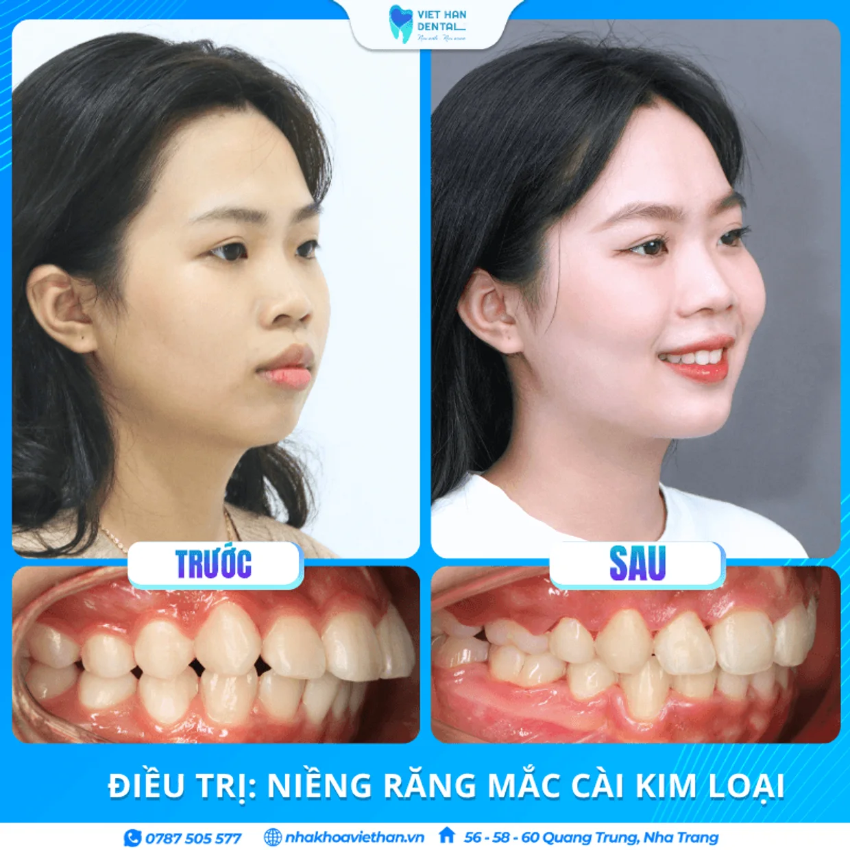 Hình ảnh hành trình niềng răng thực tế của khách hàng Huyền Diệu