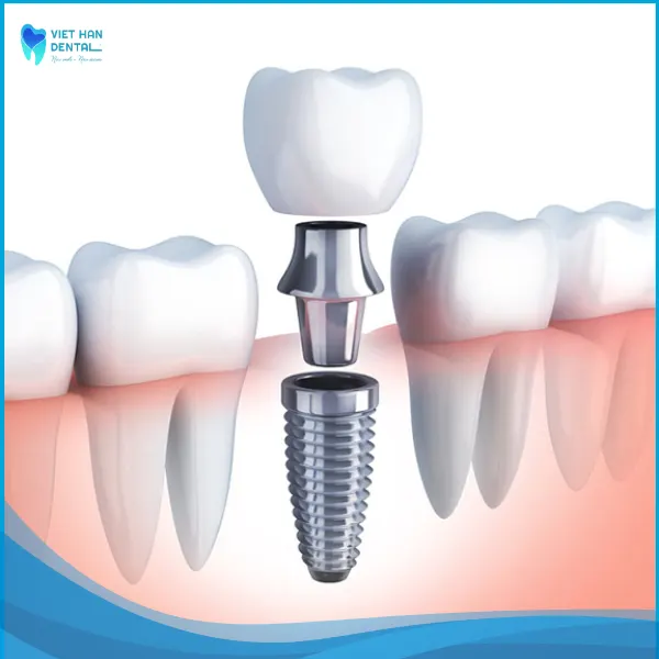 Kế hoạch và thời gian trồng răng implant