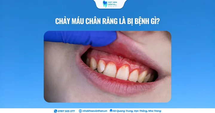 Chảy máu chân răng là bị bệnh gì?