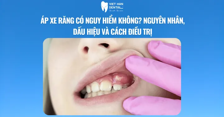 Áp xe răng có nguy hiểm không? Nguyên nhân, dấu hiệu và cách điều trị