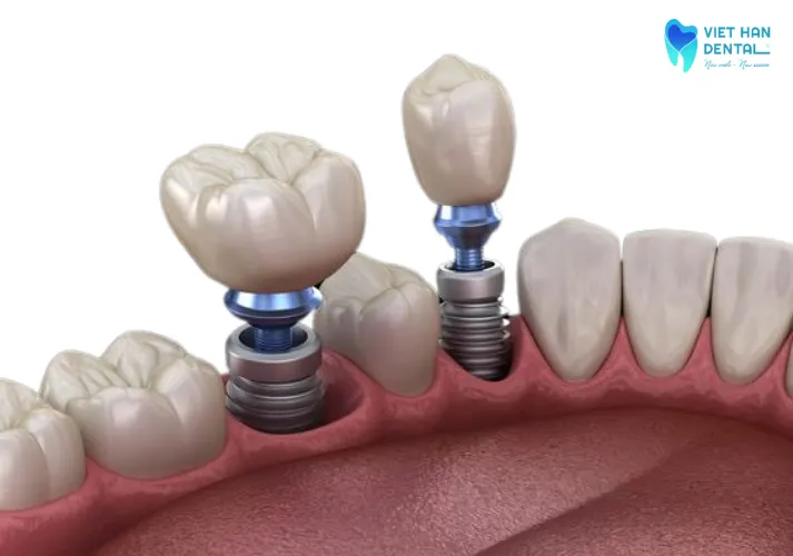 Trồng răng implant là gì?