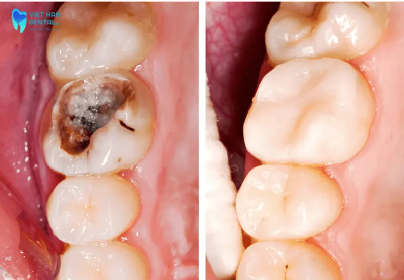 Răng bị sâu trước và sau khi trám răng