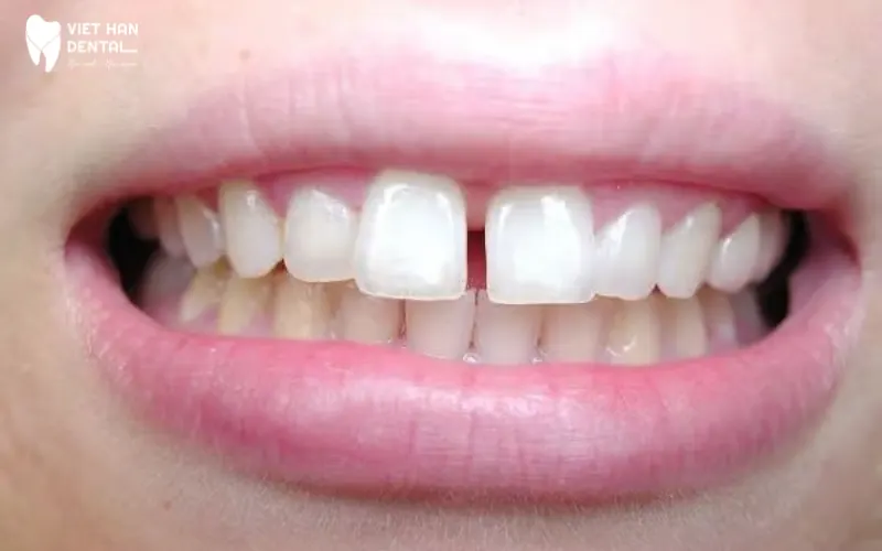 Trám răng chỉ áp dụng trường hợp răng thưa có khoảng hở nhỏ dưới 2mm