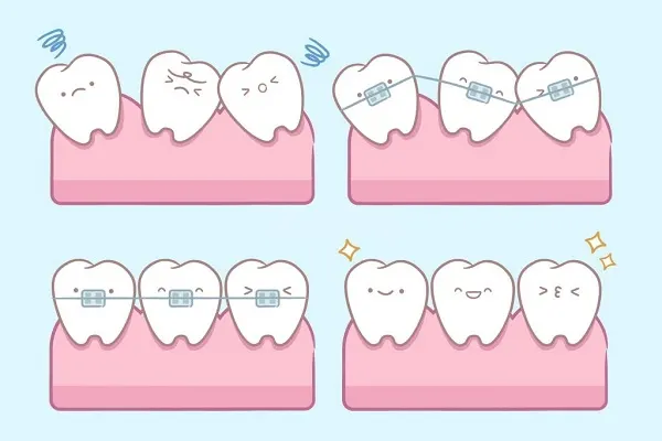 How braces work