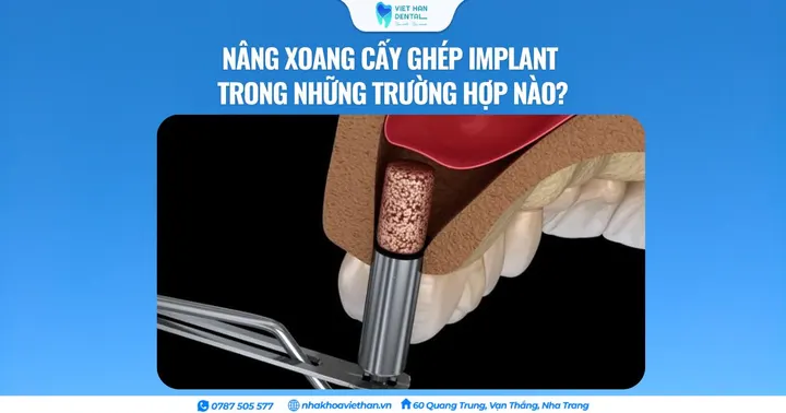 Nâng xoang cấy ghép Implant trong những trường hợp nào?