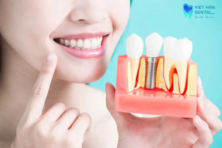 How long do dental implants last?