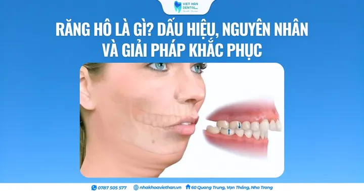 Răng hô là gì? Dấu hiệu, nguyên nhân và giải pháp khắc phục