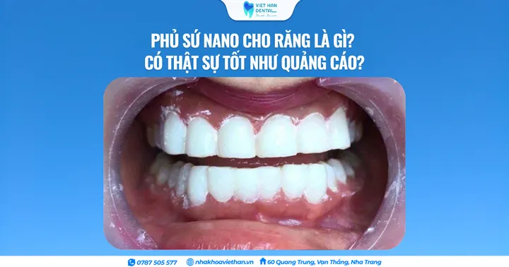 Phủ sứ nano cho răng là gì? Có thật sự tốt như quảng cáo?