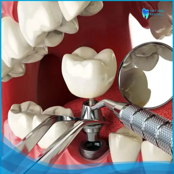 Phẫu thuật cấy ghép trụ Implant (7 – 10 phút/trụ Implant)