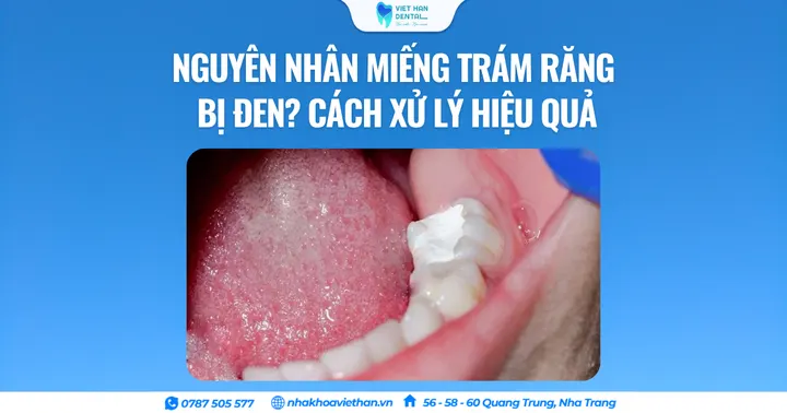 Nguyên nhân miếng trám răng bị đen? Cách xử lý hiệu quả