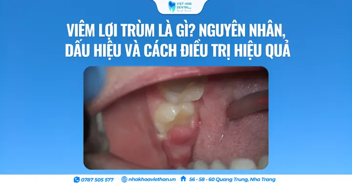 Viêm lợi trùm là gì? Nguyên nhân, dấu hiệu và cách điều trị hiệu quả