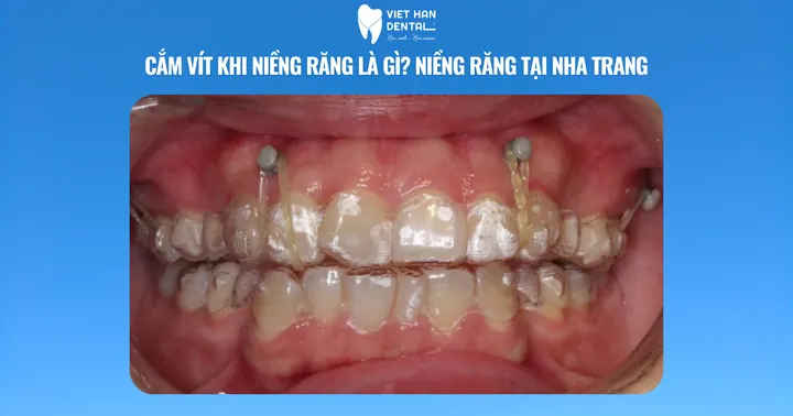 Cắm vít khi niềng răng là gì? Niềng răng tại Nha Trang