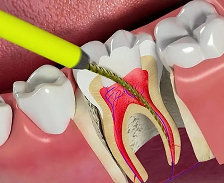 Điều trị tủy răng có đau không?