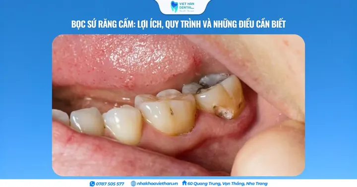 Bọc sứ răng cấm: Lợi ích, quy trình và những điều cần biết