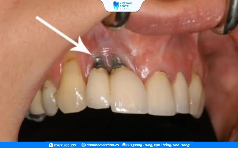 Kỹ thuật cấy ghép không đảm bảo dẫn đến tình trạng răng Implant bị lung lay
